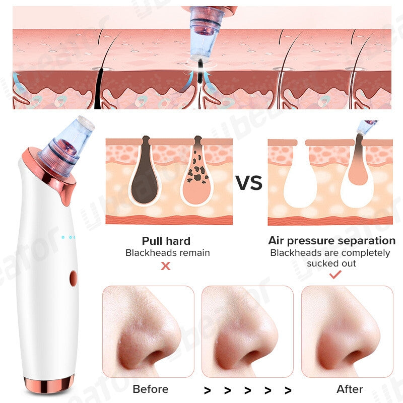 Blackhead and Pore Remover electric