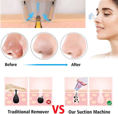 Blackhead and Pore Remover electric